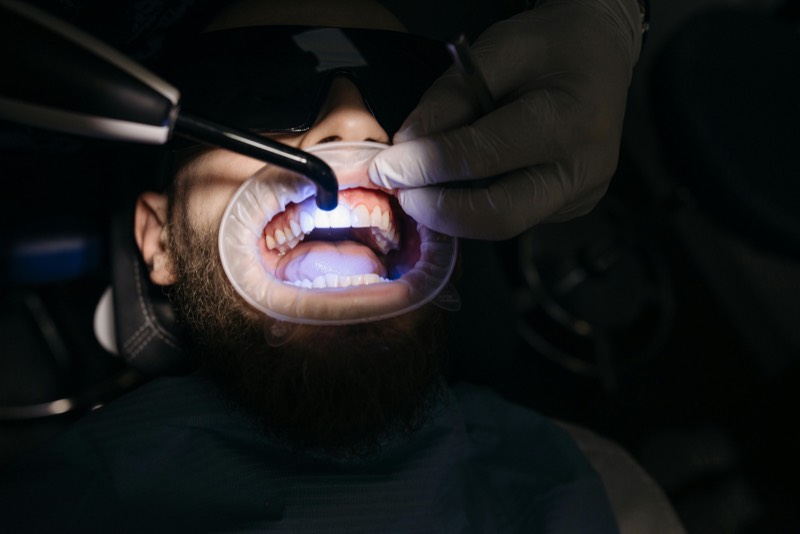Bonding composite - facette dentaire sans limer les dents